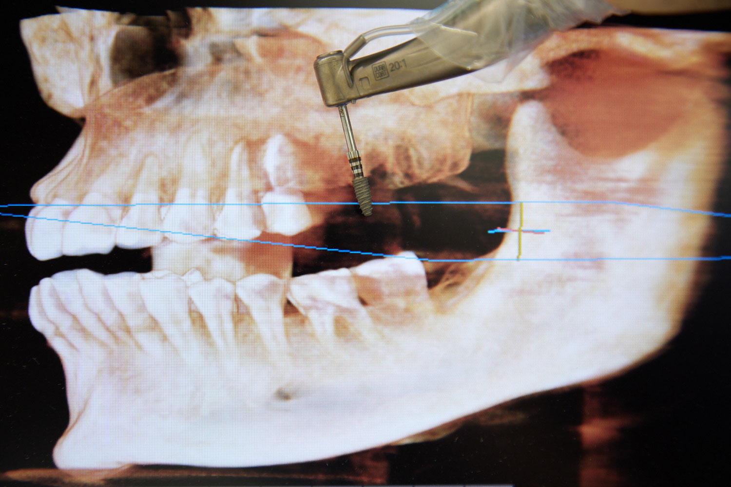 Implantologie au cabinet