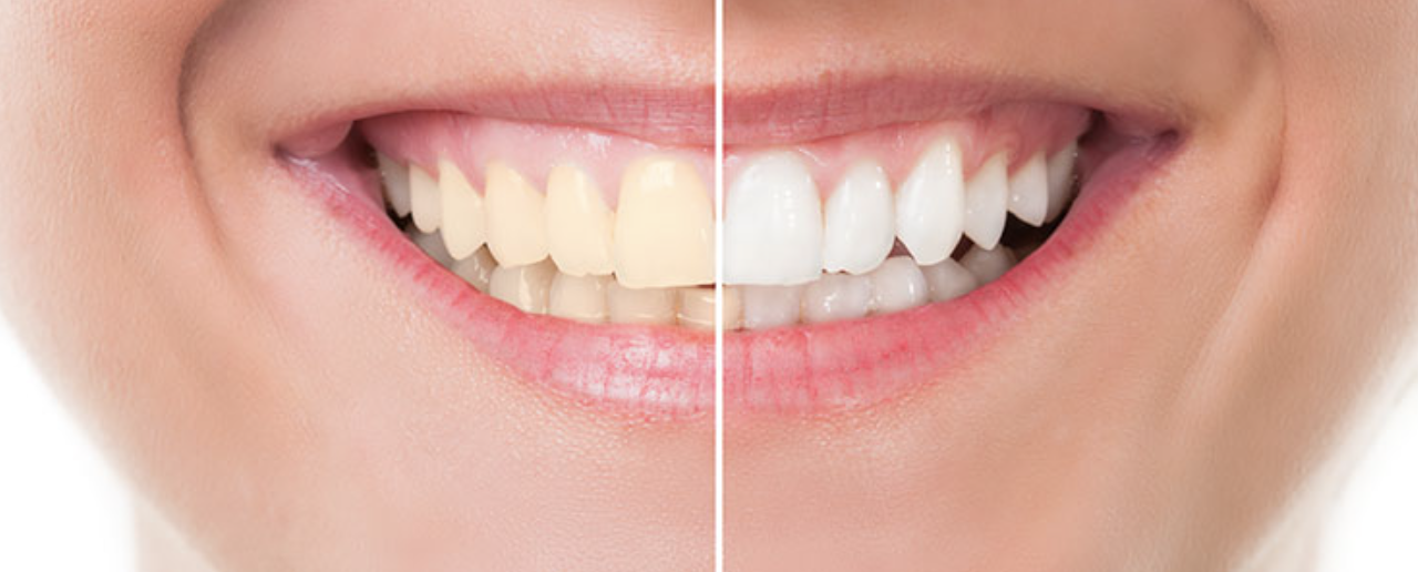 Prothèse dentaire amovible