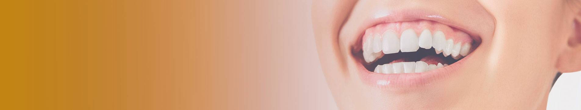 Éclaircissement dentaire