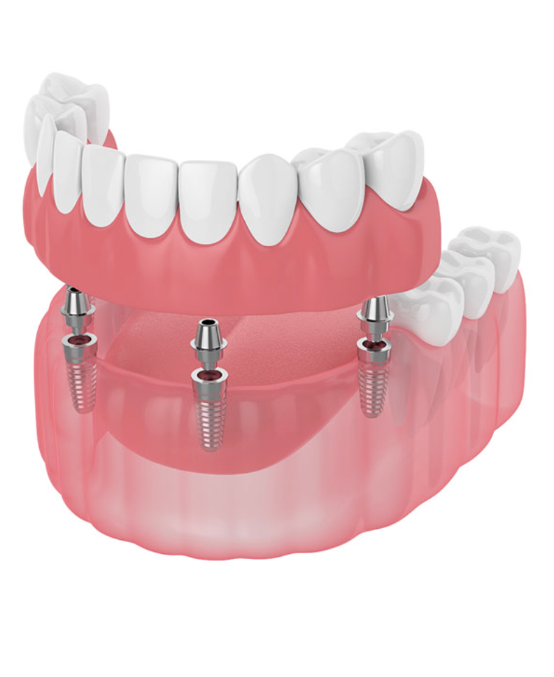 Prothèse dentaire amovible